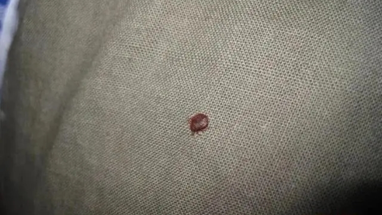 【熱門話題】做好準(zhǔn)備 應(yīng)對床蝨危機