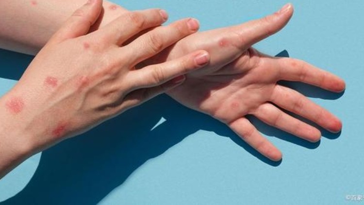 中疾控：10月新增報(bào)告127例猴痘確診病例