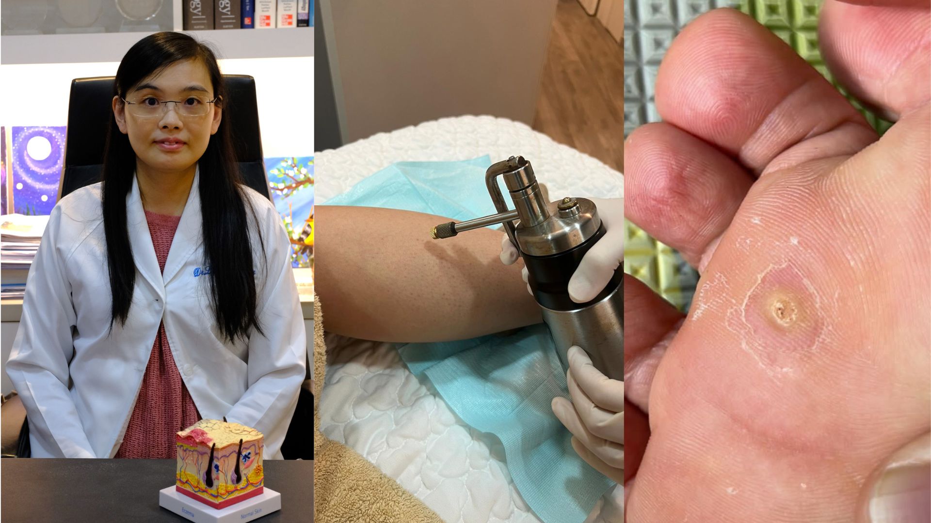 【健康】傳染性病毒疣 醫(yī)生教你如何預防