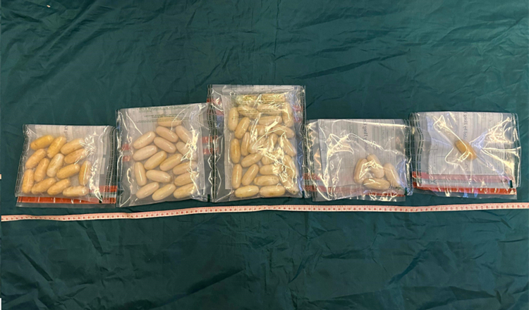 海關(guān)機(jī)場(chǎng)偵破旅客體內(nèi)藏毒案件 檢獲市值120萬(wàn)懷疑可卡因