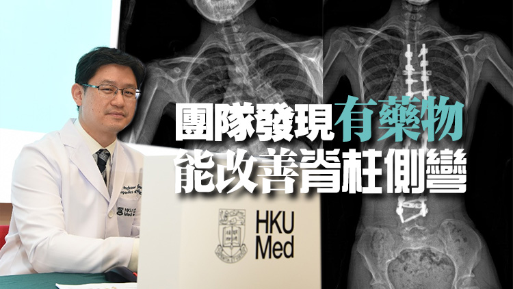 港大就原發(fā)性脊柱側彎取得全球突破  主因為SLC6A9基因變異