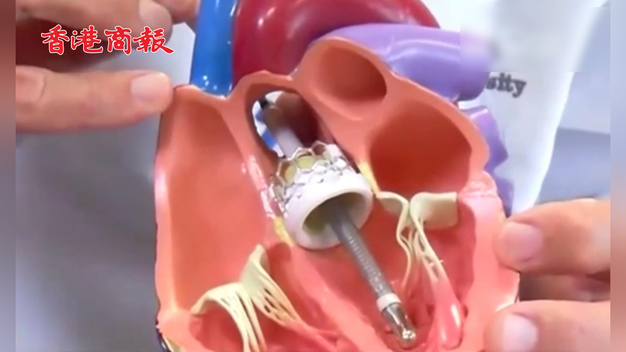 有片｜緊急召回！美國知名品牌心臟泵致49人死亡