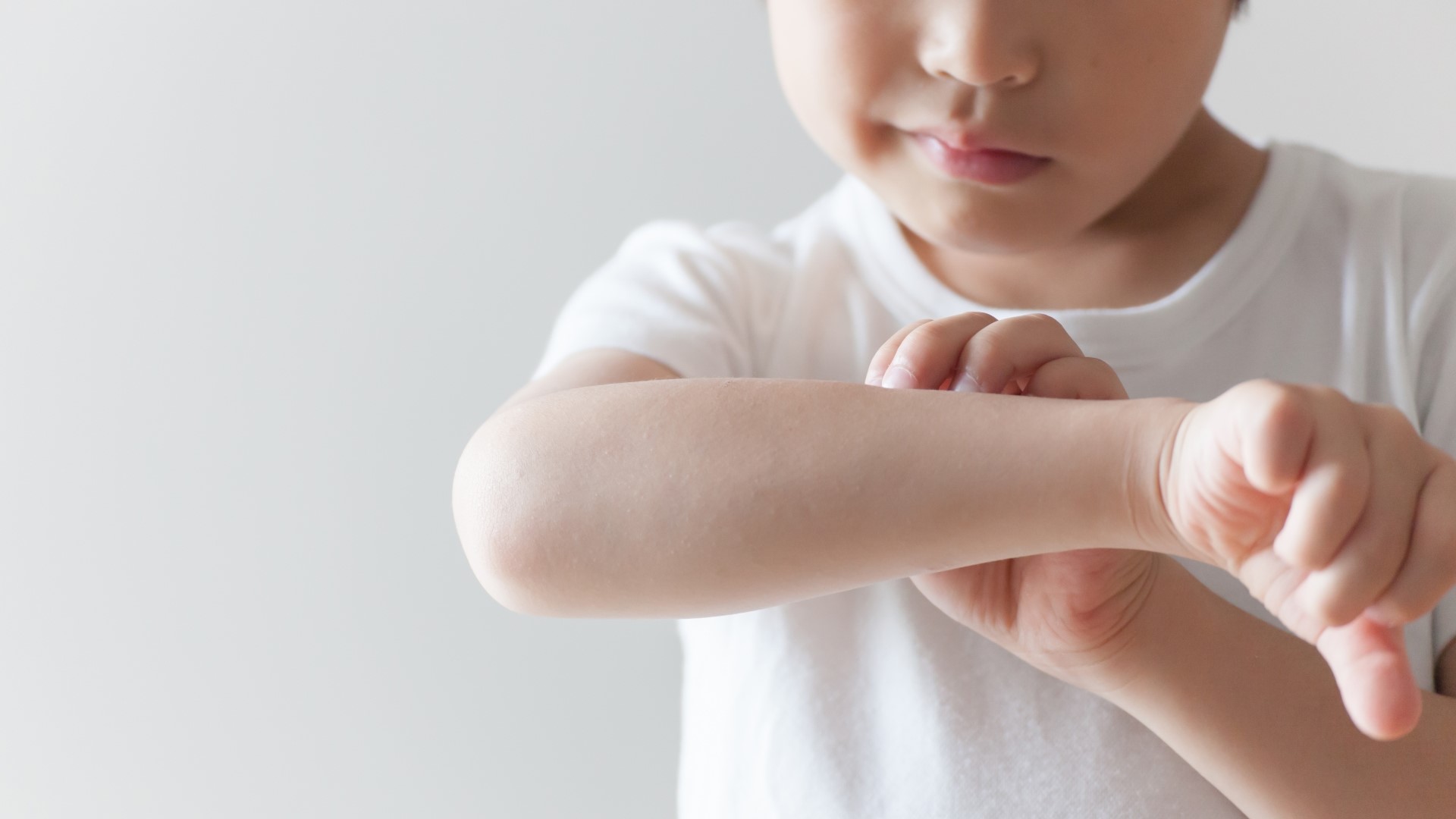 【健康】蕁麻疹的原因、癥狀和紓緩方法