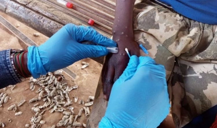 世衛(wèi)組織啟動(dòng)全球計(jì)劃遏制猴痘疫情傳播