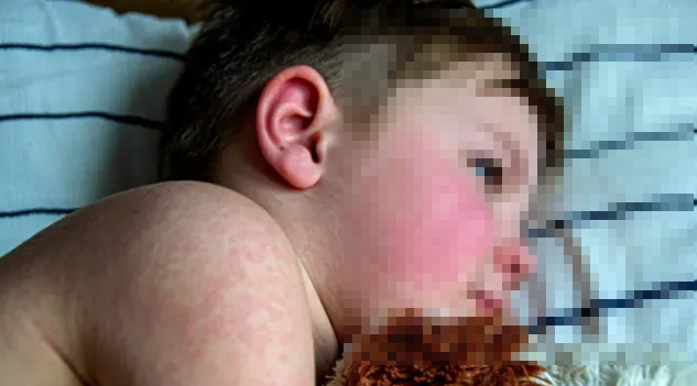 又現(xiàn)死亡病例！美國一兒童因感染麻疹死亡