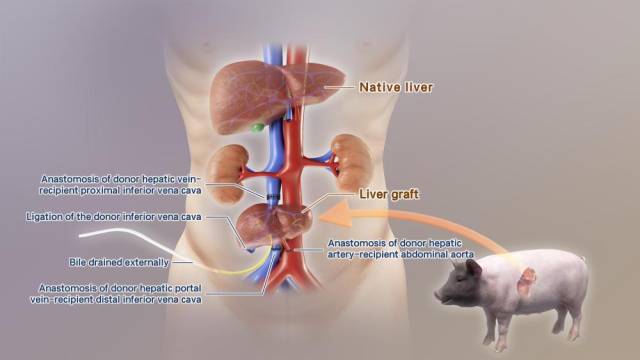 全球首例！中國團(tuán)隊(duì)成功將基因編輯豬肝臟移植人體