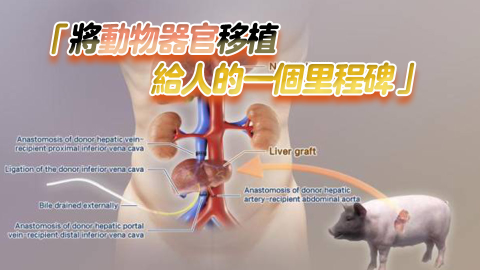 全球首例！中國團隊成功將基因編輯豬肝臟移植人體