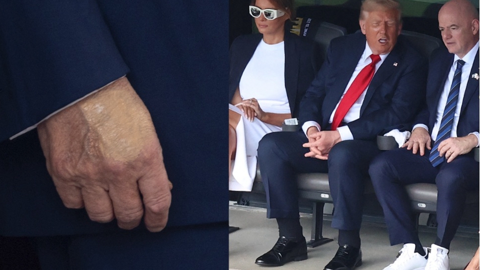 美國總統(tǒng)特朗普被確診患靜脈疾病